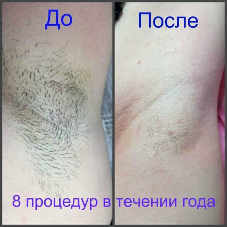 Популярные технологии удаления волос